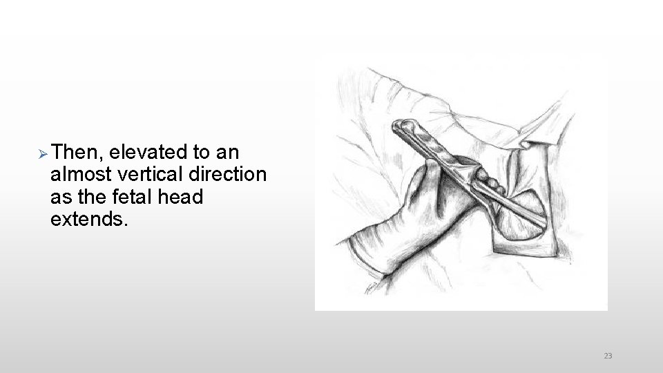  Then, elevated to an almost vertical direction as the fetal head extends. 23
