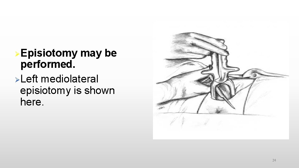  Episiotomy may be performed. Left mediolateral episiotomy is shown here. 24 