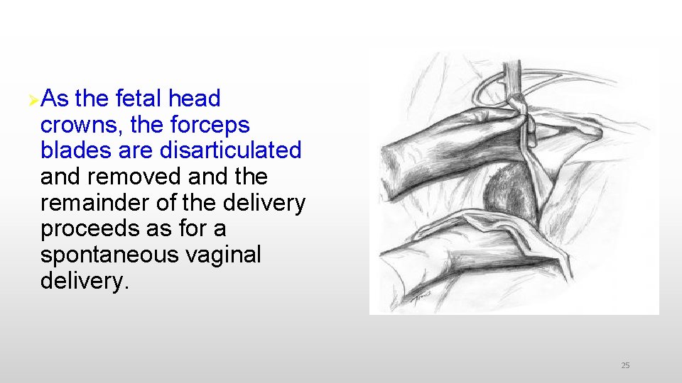  As the fetal head crowns, the forceps blades are disarticulated and removed and