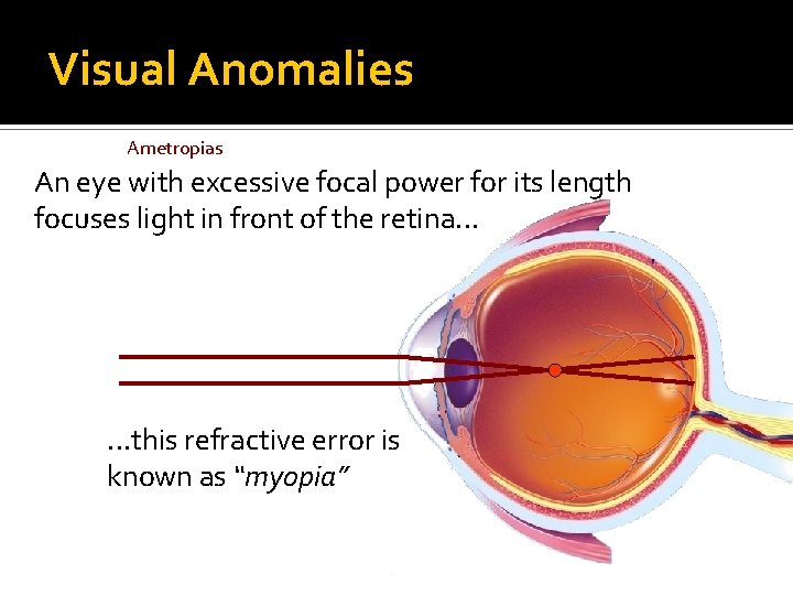 Visual Anomalies Ametropias An eye with excessive focal power for its length focuses light