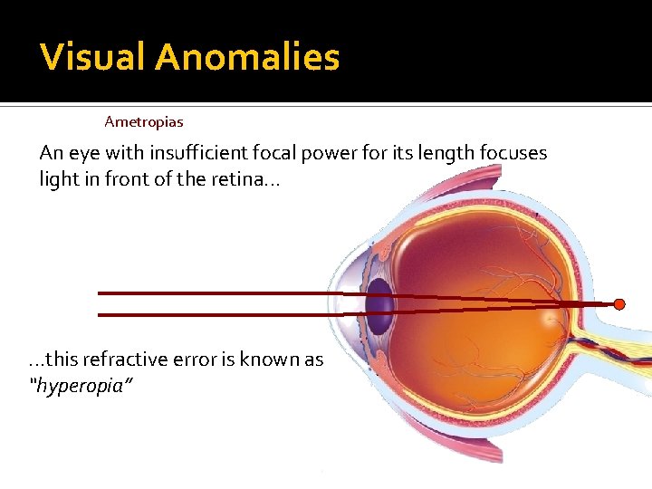 Visual Anomalies Ametropias An eye with insufficient focal power for its length focuses light