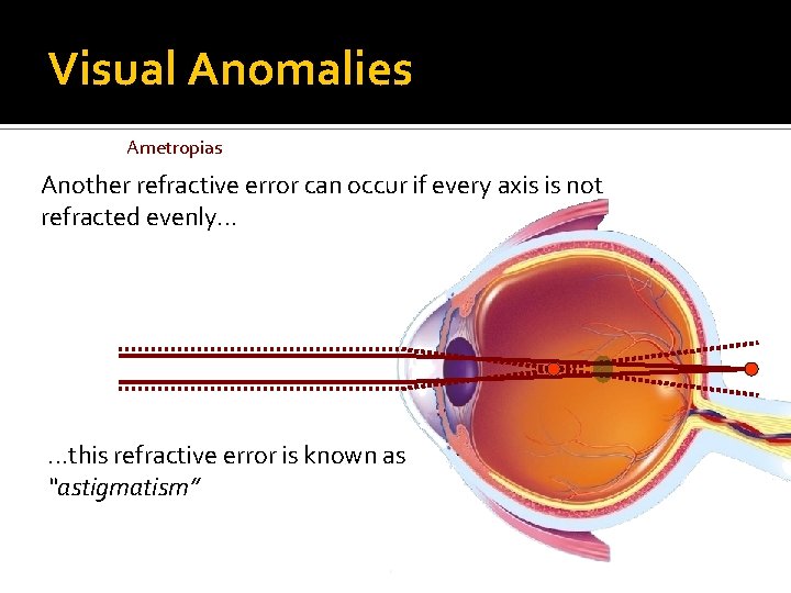 Visual Anomalies Ametropias Another refractive error can occur if every axis is not refracted