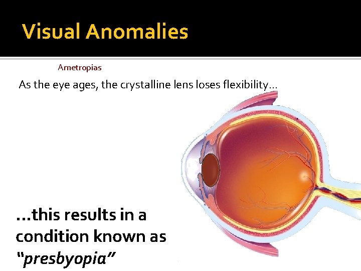 Visual Anomalies Ametropias As the eye ages, the crystalline lens loses flexibility. . .