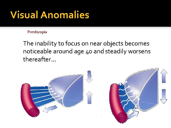 Visual Anomalies Presbyopia The inability to focus on near objects becomes noticeable around age