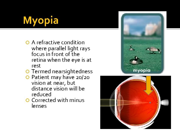 Myopia A refractive condition where parallel light rays focus in front of the retina