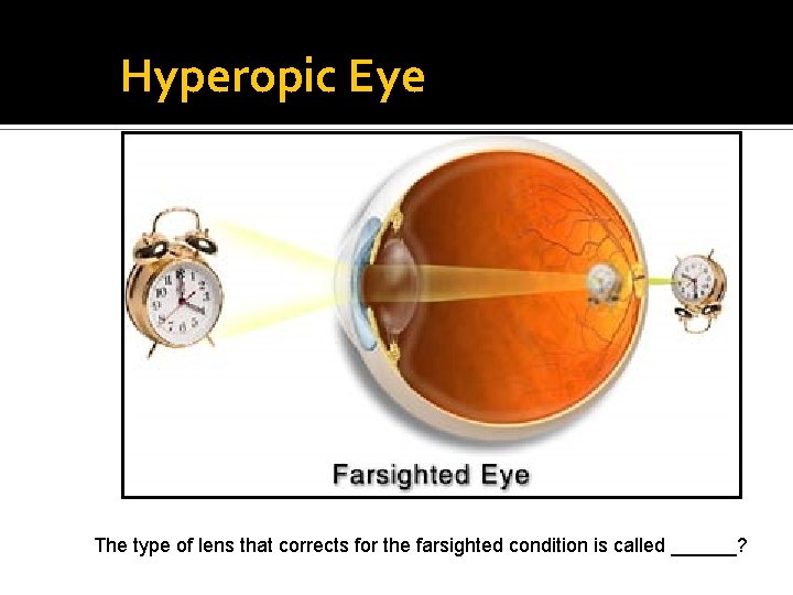 Hyperopic Eye The type of lens that corrects for the farsighted condition is called