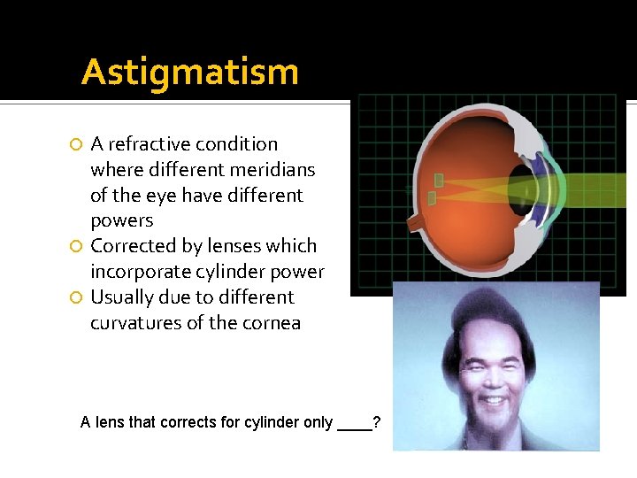 Astigmatism A refractive condition where different meridians of the eye have different powers Corrected