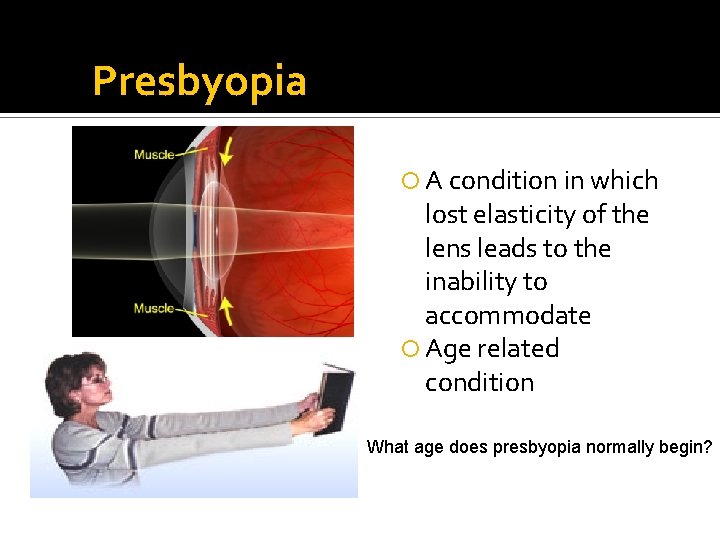 Presbyopia A condition in which lost elasticity of the lens leads to the inability