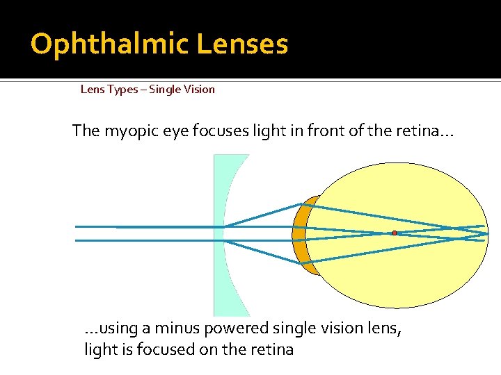 Ophthalmic Lenses Lens Types – Single Vision The myopic eye focuses light in front