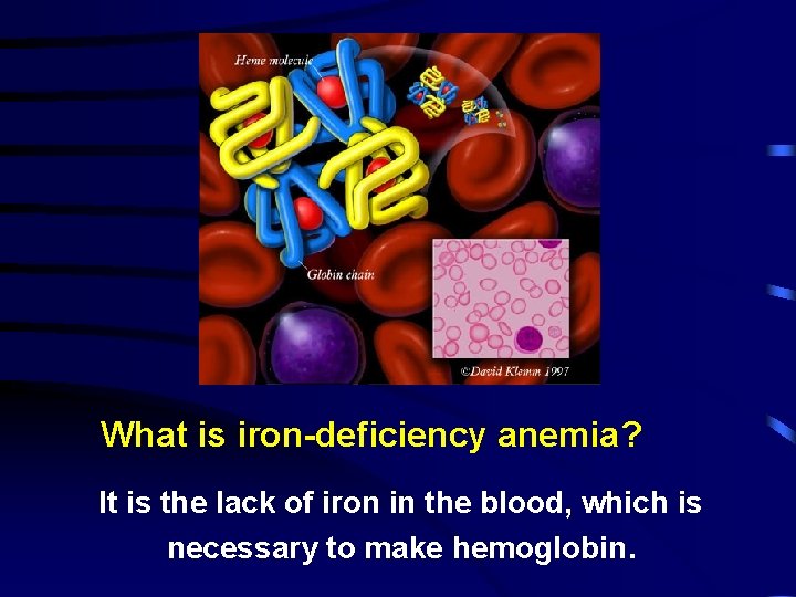 What is iron-deficiency anemia? It is the lack of iron in the blood, which