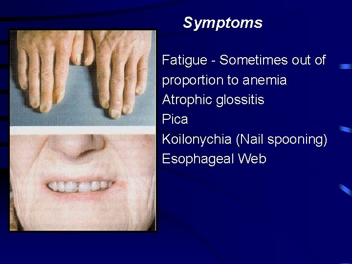 Symptoms Fatigue - Sometimes out of proportion to anemia Atrophic glossitis Pica Koilonychia (Nail