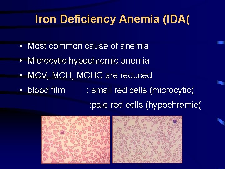 Iron Deficiency Anemia (IDA( • Most common cause of anemia • Microcytic hypochromic anemia