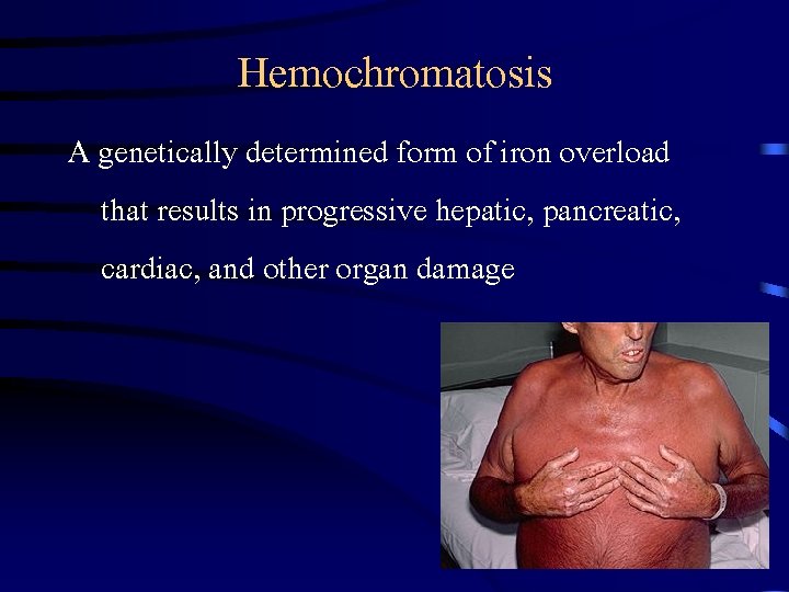 Hemochromatosis A genetically determined form of iron overload that results in progressive hepatic, pancreatic,