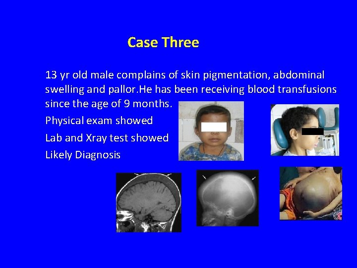 Case Three 13 yr old male complains of skin pigmentation, abdominal swelling and pallor.