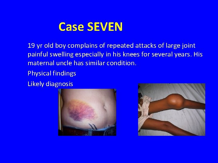 Case SEVEN 19 yr old boy complains of repeated attacks of large joint painful