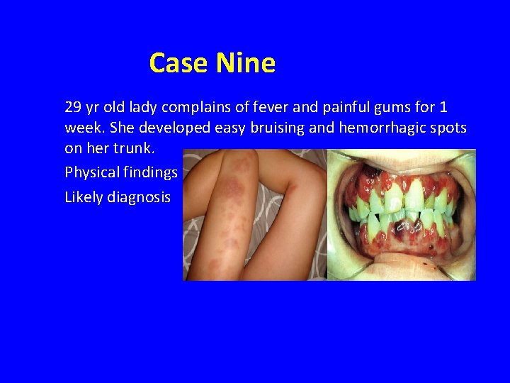 Case Nine 29 yr old lady complains of fever and painful gums for 1