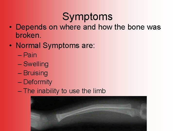 Symptoms • Depends on where and how the bone was broken. • Normal Symptoms