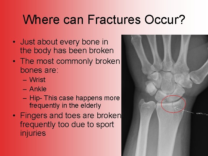 Where can Fractures Occur? • Just about every bone in the body has been