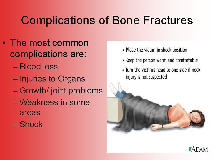 Complications of Bone Fractures • The most common complications are: – Blood loss –