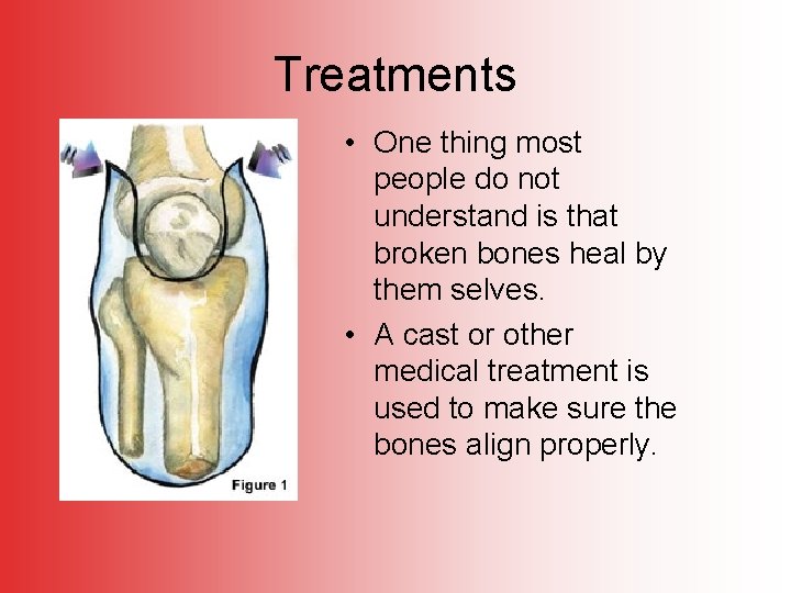 Treatments • One thing most people do not understand is that broken bones heal