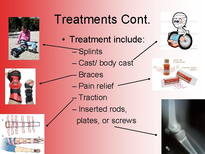 Treatments Cont. • Treatment include: – Splints – Cast/ body cast – Braces –