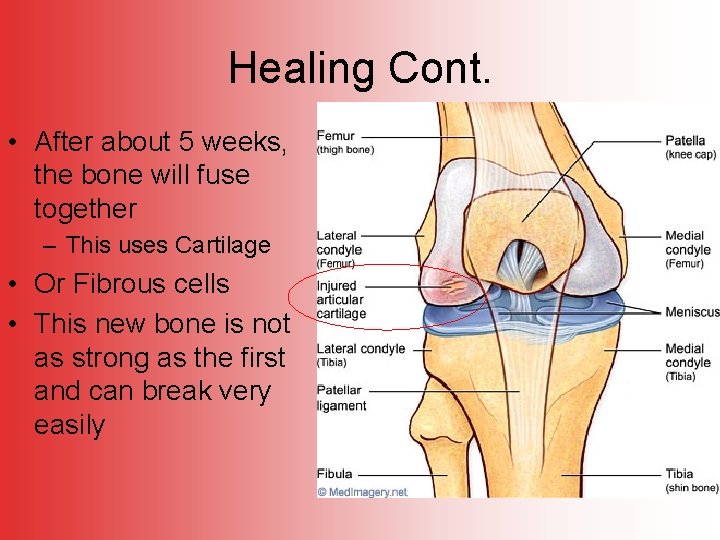 Healing Cont. • After about 5 weeks, the bone will fuse together – This