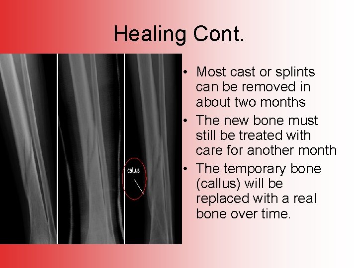 Healing Cont. • Most cast or splints can be removed in about two months
