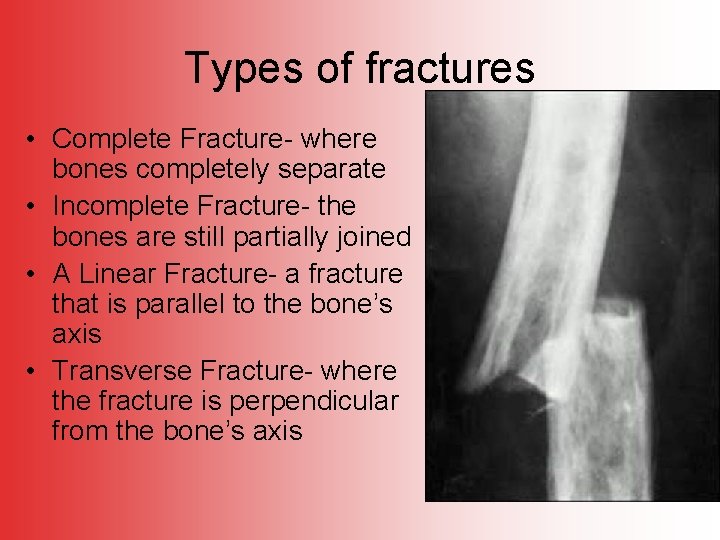 Types of fractures • Complete Fracture- where bones completely separate • Incomplete Fracture- the