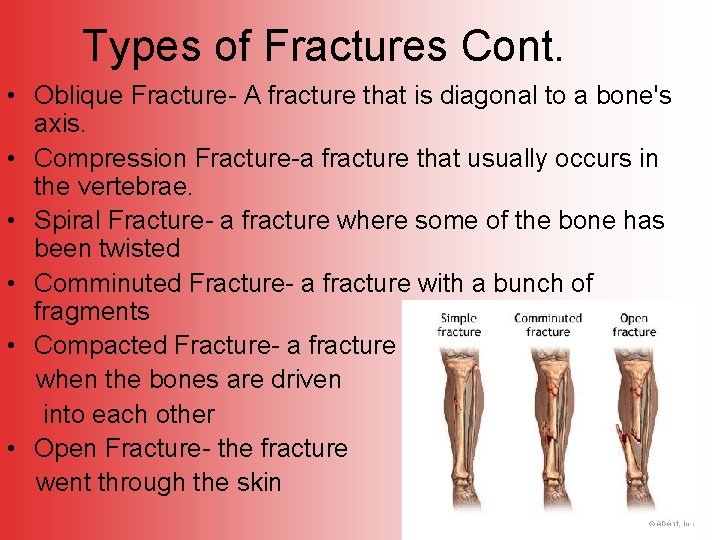 Types of Fractures Cont. • Oblique Fracture- A fracture that is diagonal to a