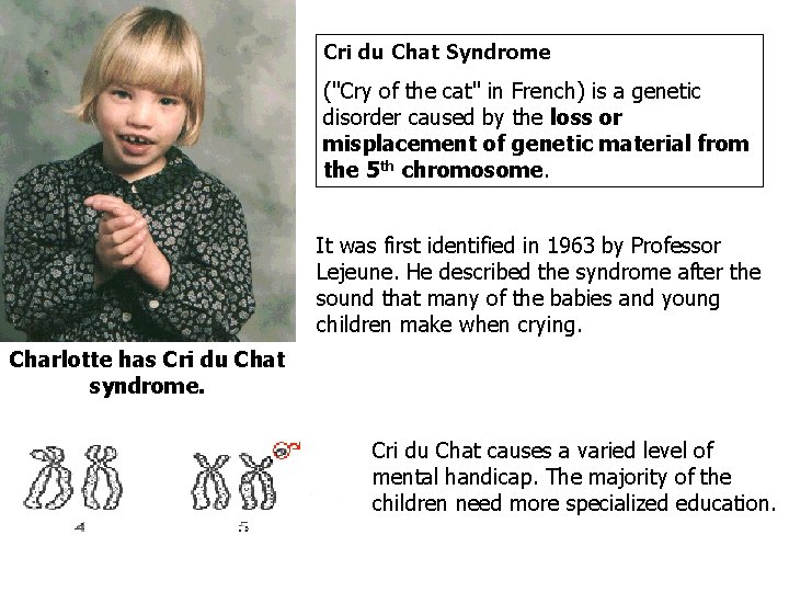 Cri du Chat Syndrome ("Cry of the cat" in French) is a genetic disorder