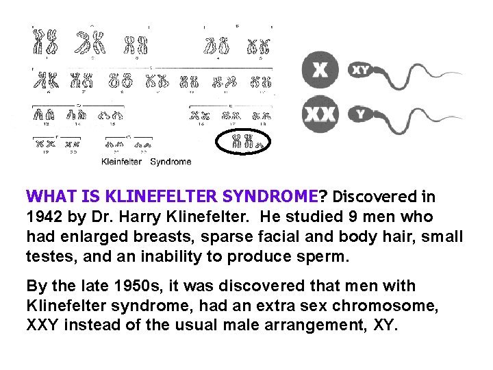 WHAT IS KLINEFELTER SYNDROME? Discovered in 1942 by Dr. Harry Klinefelter. He studied 9