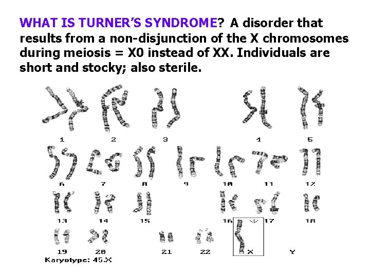 WHAT IS TURNER’S SYNDROME? A disorder that results from a non-disjunction of the X