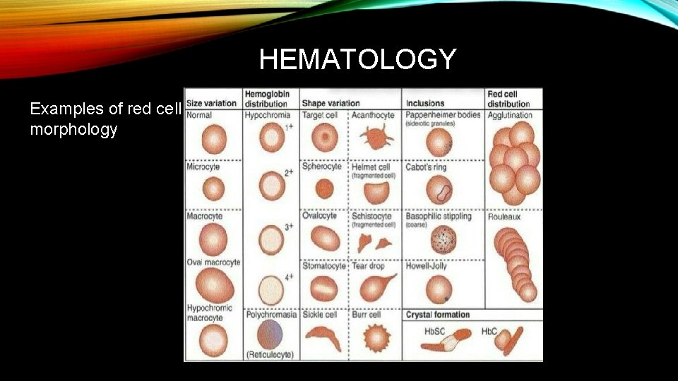 HEMATOLOGY Examples of red cell morphology 