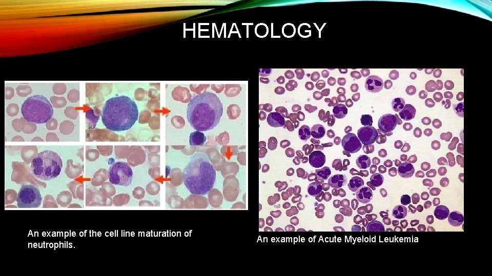 HEMATOLOGY An example of the cell line maturation of neutrophils. An example of Acute