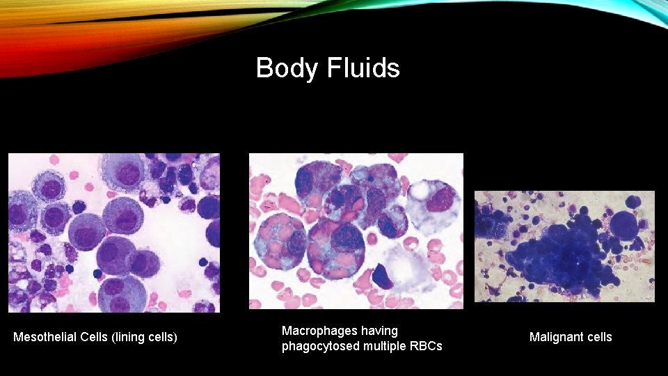 Body Fluids Mesothelial Cells (lining cells) Macrophages having phagocytosed multiple RBCs Malignant cells 