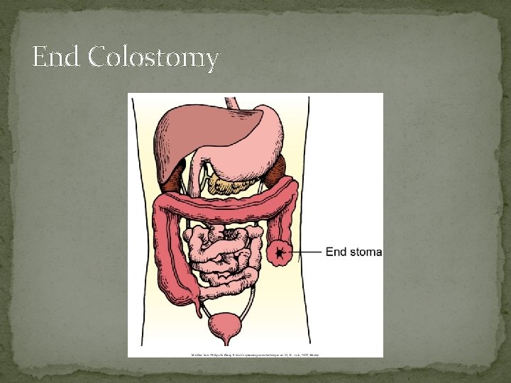 End Colostomy 