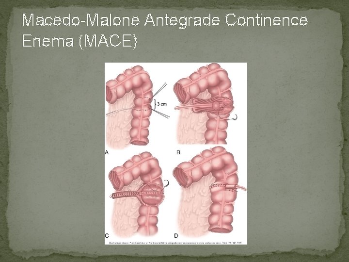 Macedo-Malone Antegrade Continence Enema (MACE) 