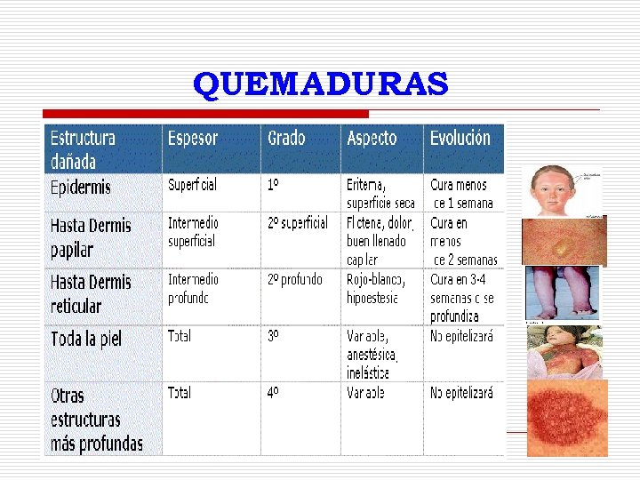 QUEMADURAS 