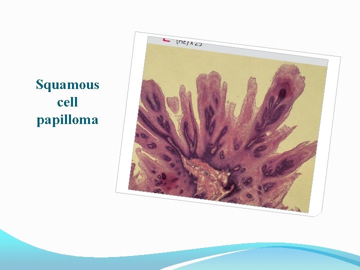Squamous cell papilloma 