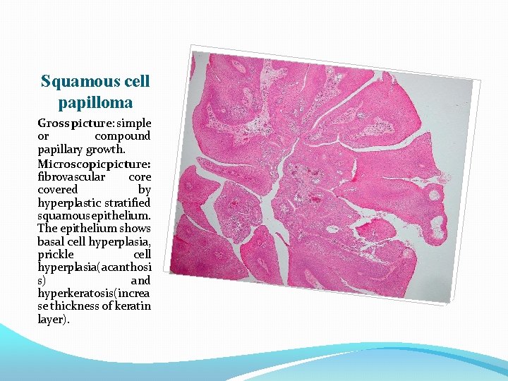 Squamous cell papilloma Gross picture: simple or compound papillary growth. Microscopic picture: fibrovascular core