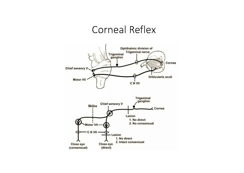 Corneal Reflex 