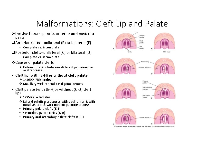 Malformations: Cleft Lip and Palate Incisive fossa separates anterior and posterior parts Anterior clefts