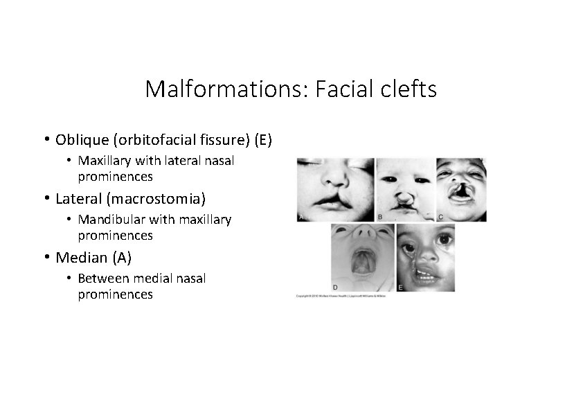 Malformations: Facial clefts • Oblique (orbitofacial fissure) (E) • Maxillary with lateral nasal prominences