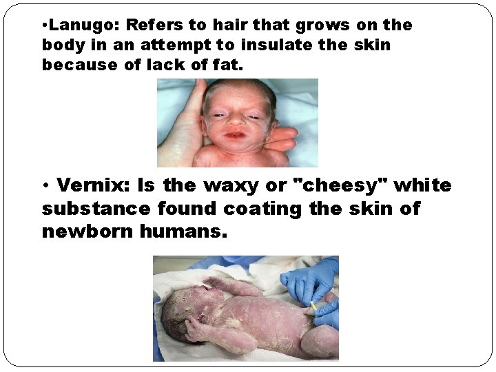  • Lanugo: Refers to hair that grows on the body in an attempt