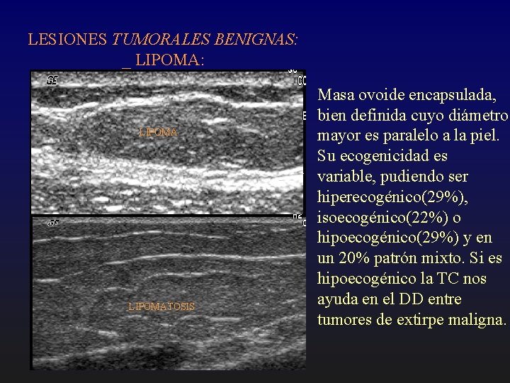 LESIONES TUMORALES BENIGNAS: _ LIPOMA: LIPOMATOSIS Masa ovoide encapsulada, bien definida cuyo diámetro mayor
