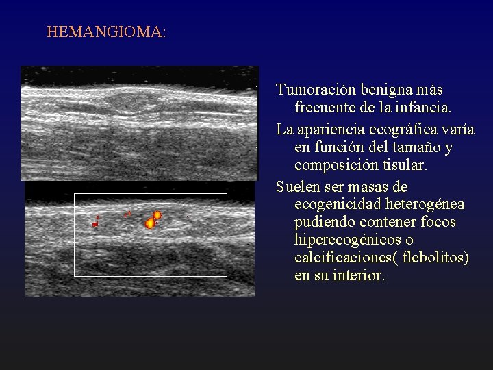 HEMANGIOMA: Tumoración benigna más frecuente de la infancia. La apariencia ecográfica varía en función