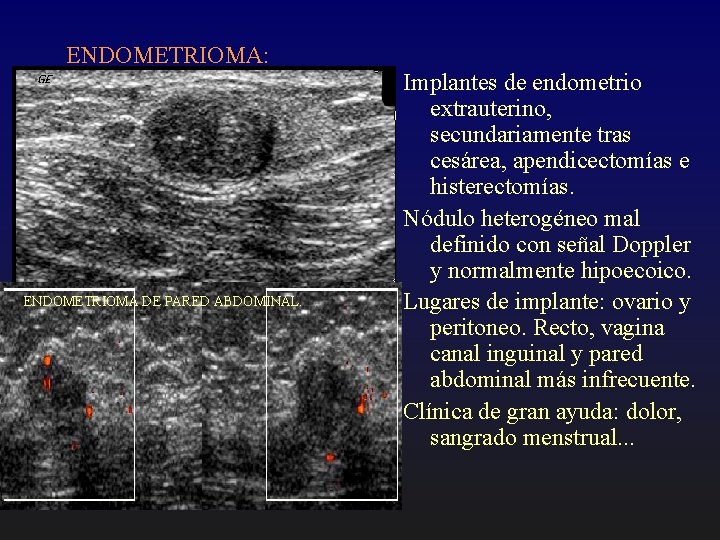 ENDOMETRIOMA: ENDOMETRIOMA DE PARED ABDOMINAL. Implantes de endometrio extrauterino, secundariamente tras cesárea, apendicectomías e