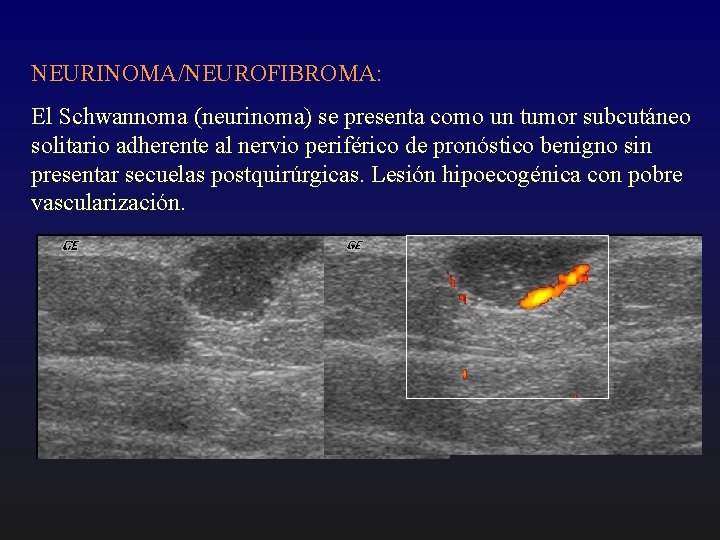 NEURINOMA/NEUROFIBROMA: El Schwannoma (neurinoma) se presenta como un tumor subcutáneo solitario adherente al nervio