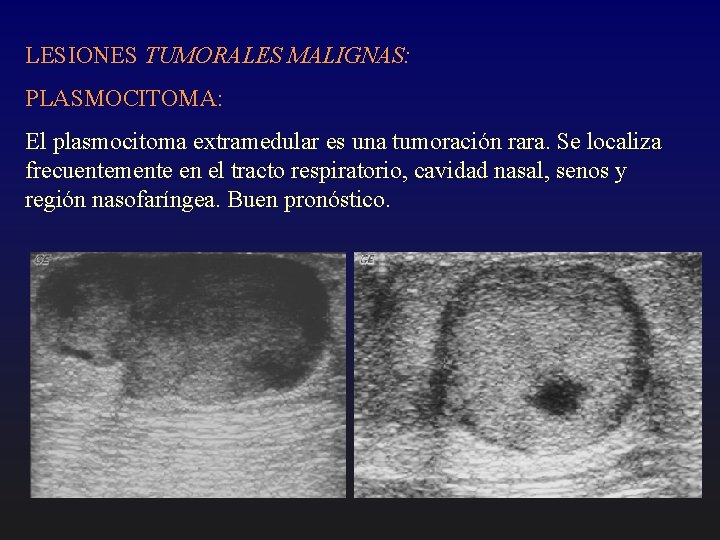 LESIONES TUMORALES MALIGNAS: PLASMOCITOMA: El plasmocitoma extramedular es una tumoración rara. Se localiza frecuentemente