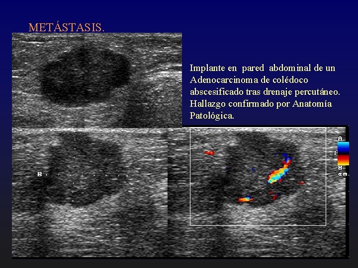 METÁSTASIS. Implante en pared abdominal de un Adenocarcinoma de colédoco abscesificado tras drenaje percutáneo.